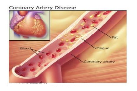 Angina Pectoris